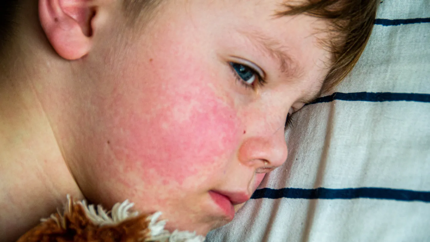 123rf_Measles_rash